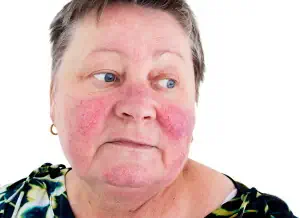 Rosacea ist eine chronische Hautkrankheit, die vor allem das Gesicht betrifft.