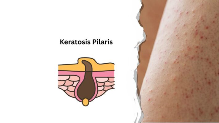 Keratosis Pilaris behandeln : 7 wirksame Tipps für glatte Haut. Erfahre Ursachen, Pflege-Routine & Fehler, die du vermeiden solltest! arganim